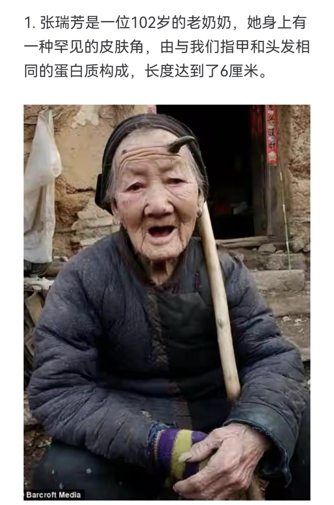 一种罕见的皮肤角，由与我们指甲和头发相同的蛋白质构成，长度达到了6厘米