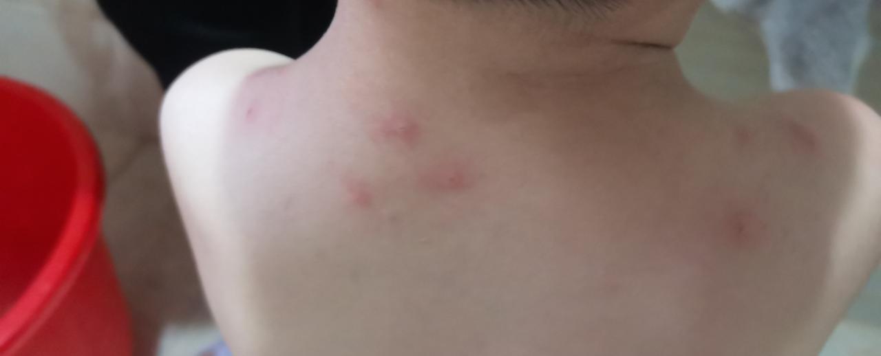 回老家一趟，娃身上全是“红包”！防护没做好真的亏大了
 
谁懂啊！带娃回趟老家，