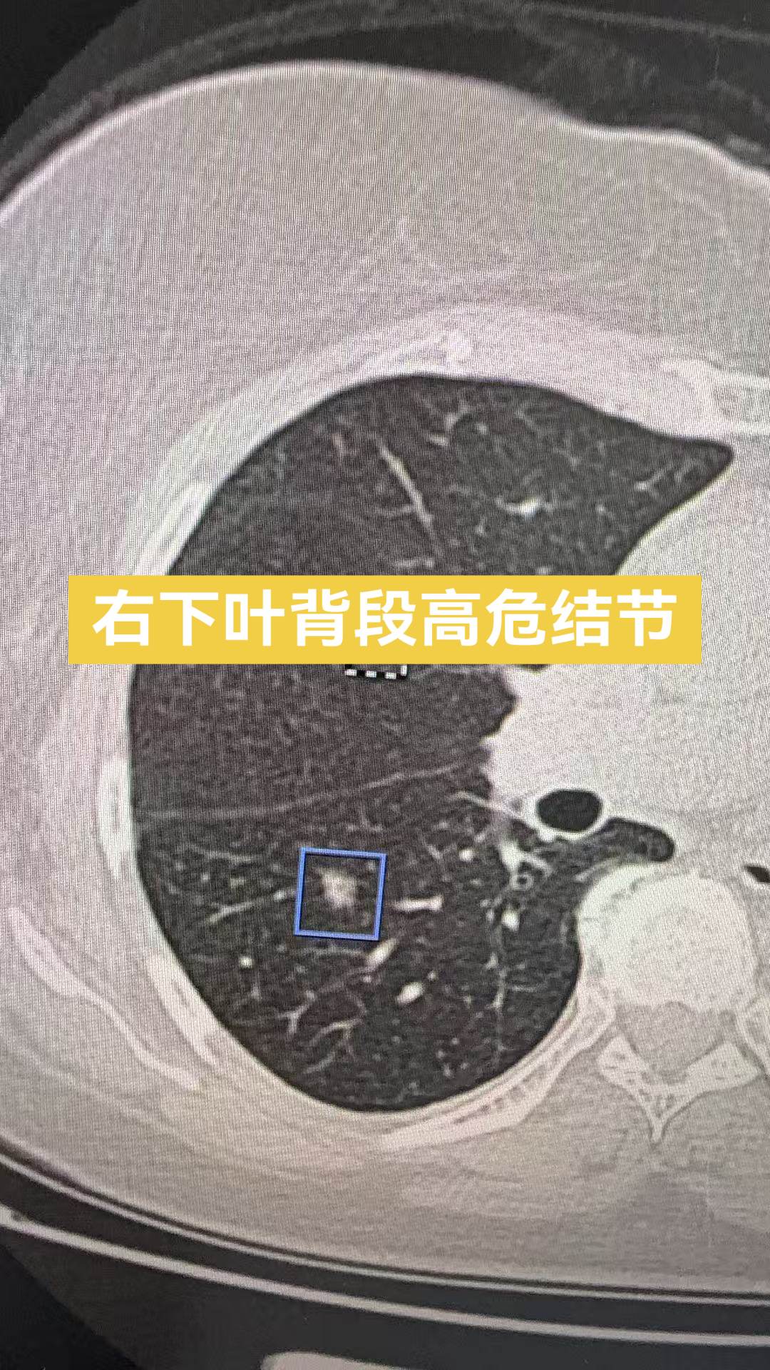 多源发肺腺癌，一次处理两个高危结节……多源发肺腺癌，一次处理两个高危结节……