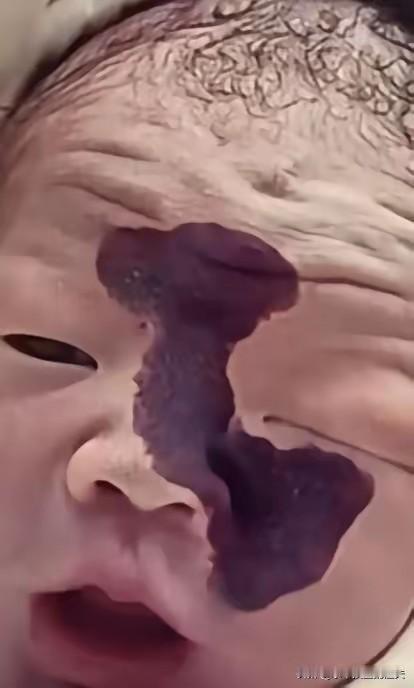 泪目！一对年轻夫妻，怀孕时在检查室看到宝宝脸上有一道黑影，医生说可能是胎记，丈夫
