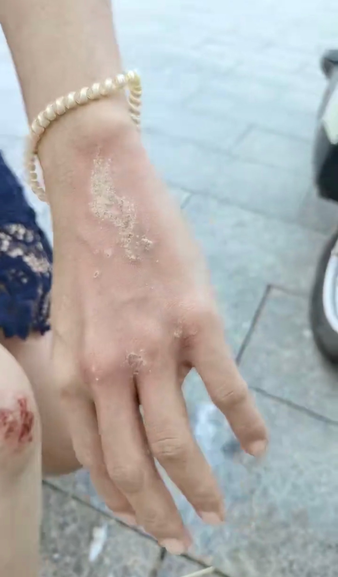 10月23日，网友反映：玉林北流女子骑车遇到路坑急刹摔倒受伤，手和脚都被擦伤了。