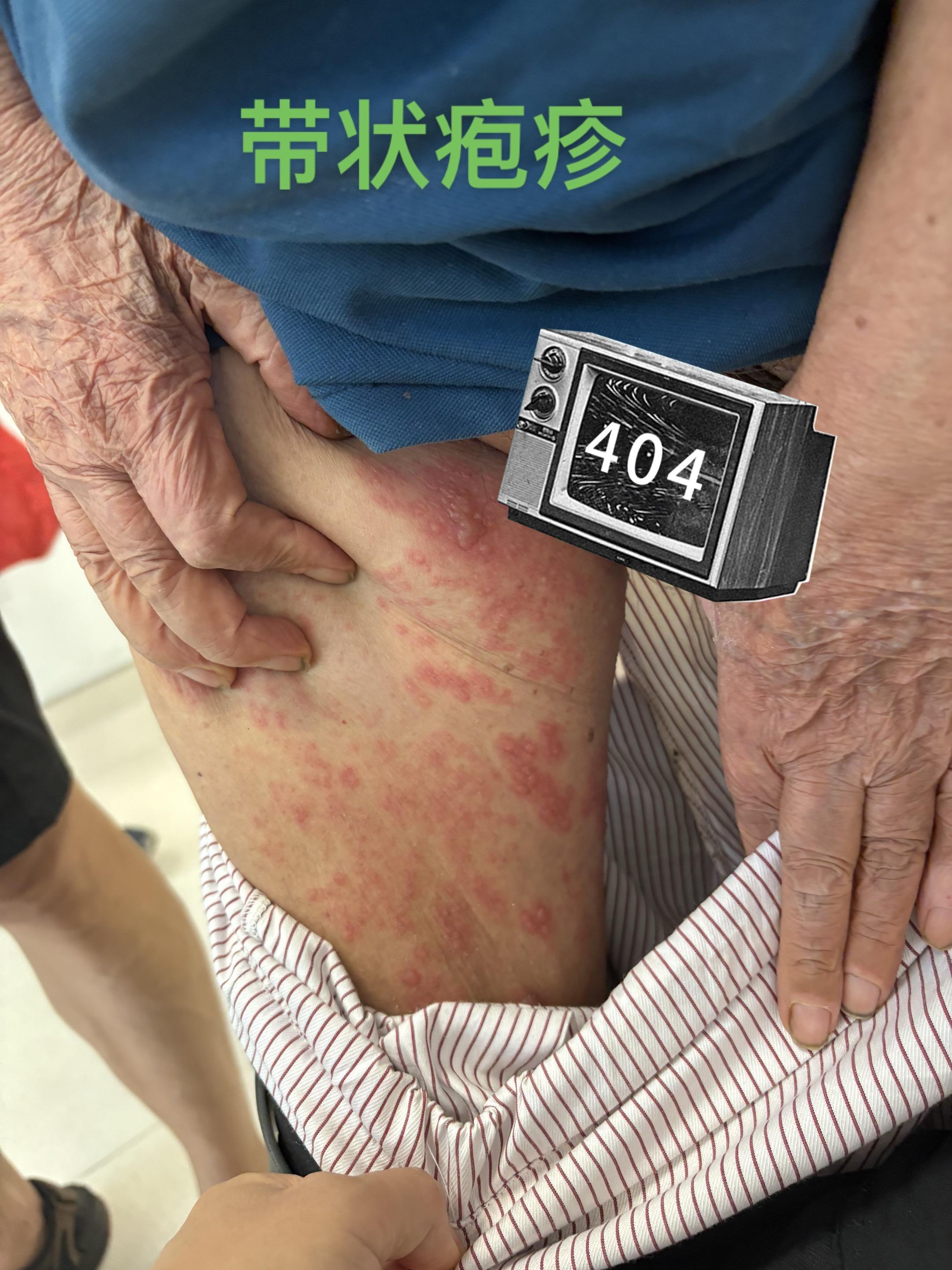 容易误诊为腰椎间盘突出的疾病。 。早期症状很像，如果影像学上也有椎间盘...