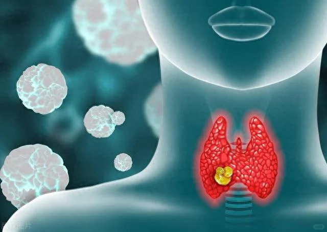 原发性甲状腺淋巴瘤的早期诊断与治疗