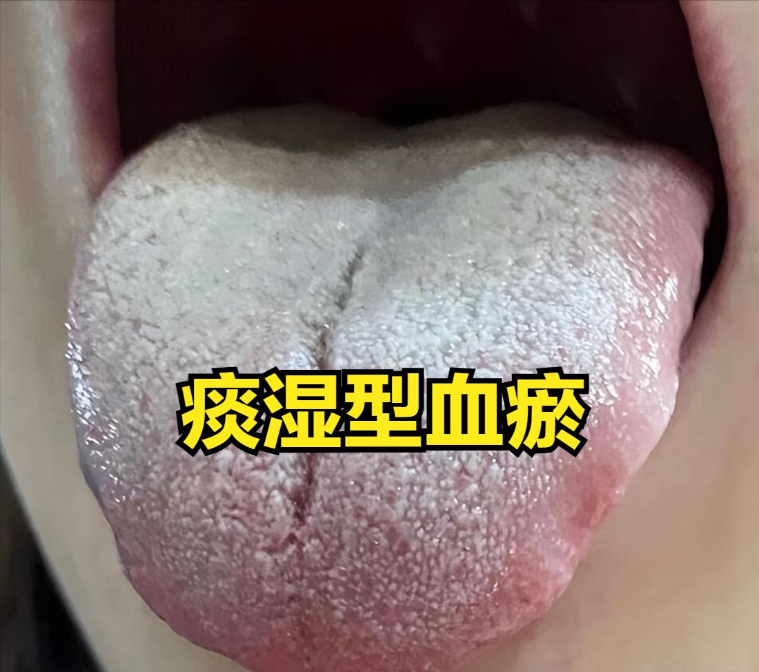 舌下青筋黑紫就要活血？错了！舌苔白腻 祛痰化瘀，舌色淡 补血化血

近期发现一个