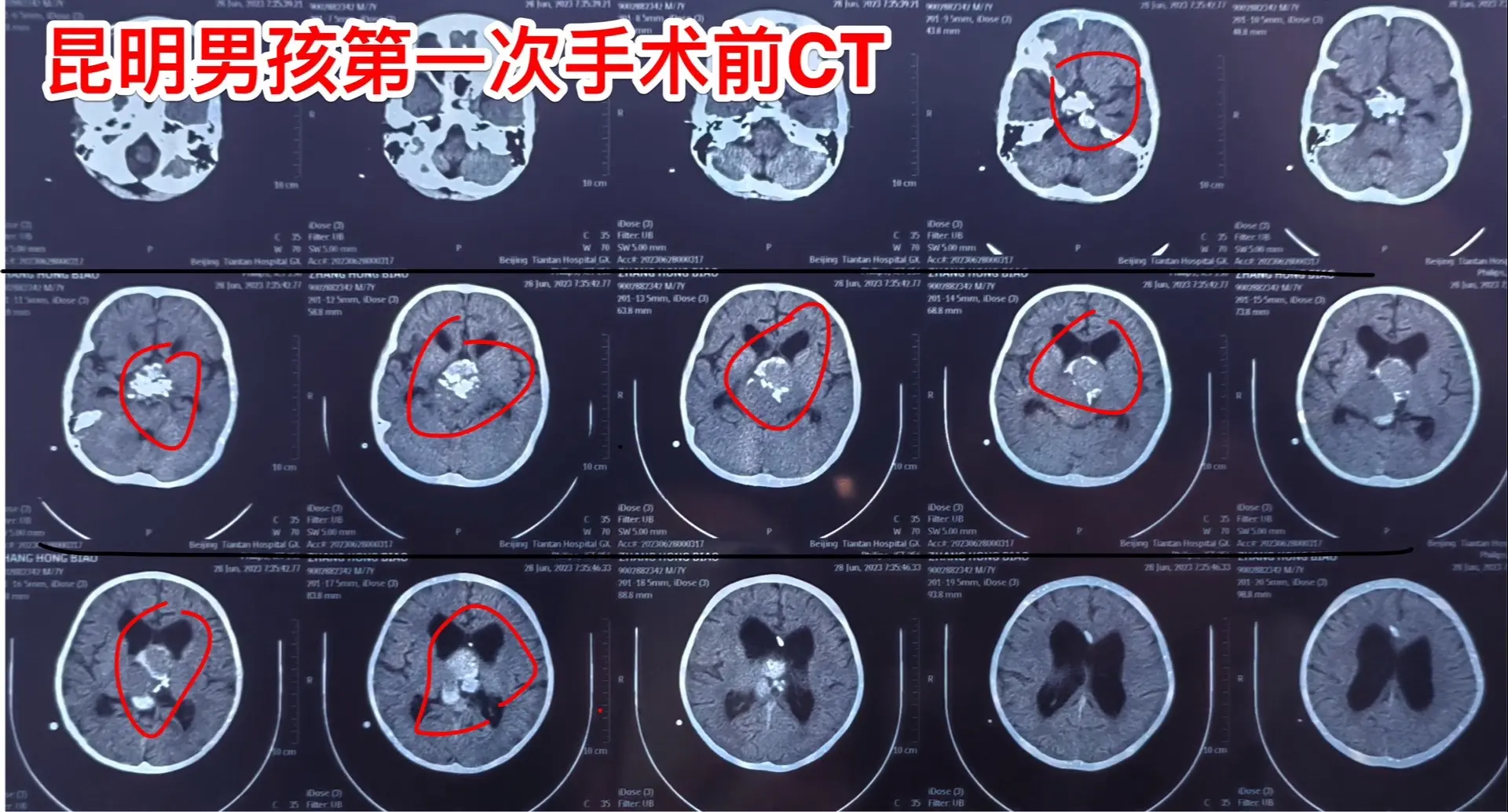 昆明男孩在14个月时间内两次大手术。昆明的8岁男孩子，2023.3在昆...