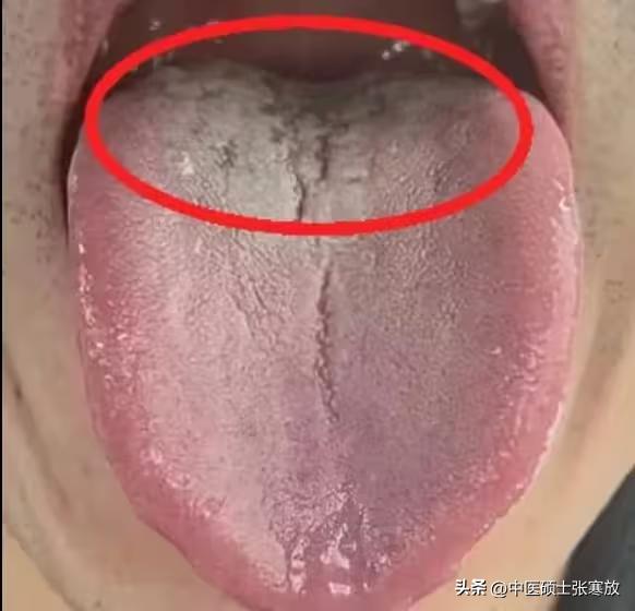 裂纹布满整个舌头，舌根更是惨白一片[捂脸][捂脸][捂脸][捂脸]
明明才二十出