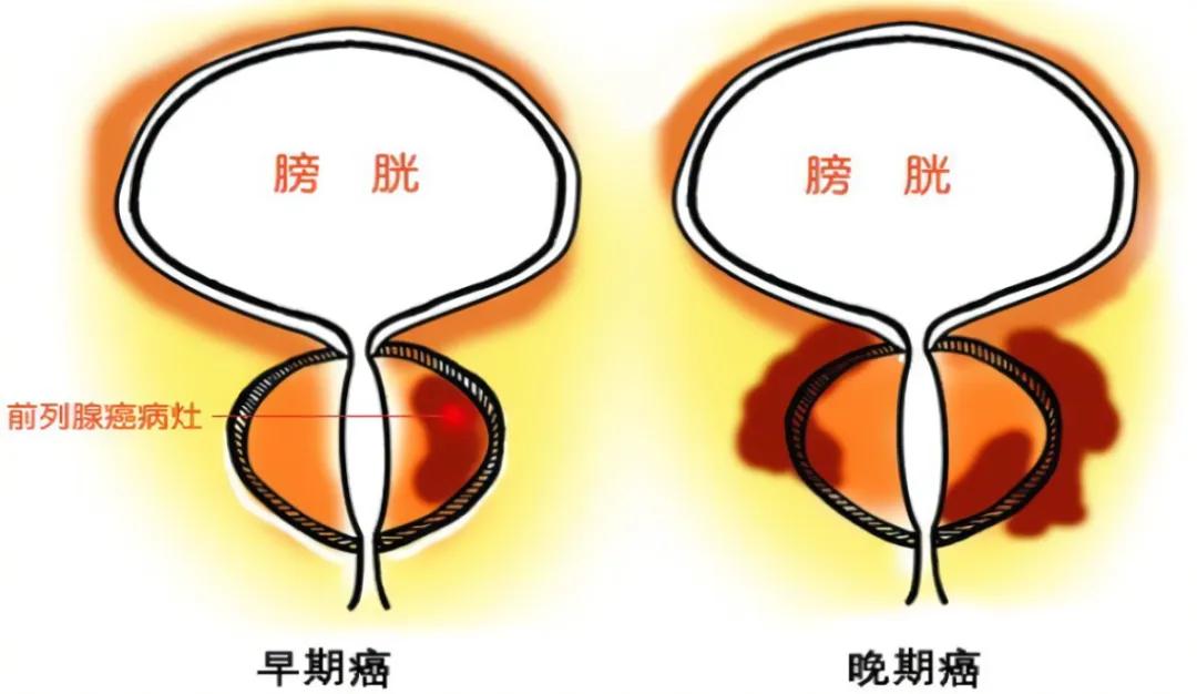 前列腺癌 新辅助内分泌治疗（NHT）适用情况
新辅助内分泌治疗：指根治性手术/放