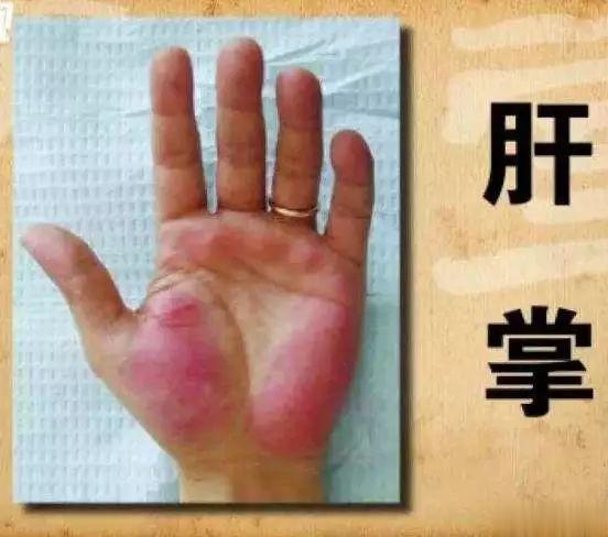 警惕肝硬化：肝癌的早期肝硬化早期，没有典型症状，所以很难被早期发现，一般就是食欲