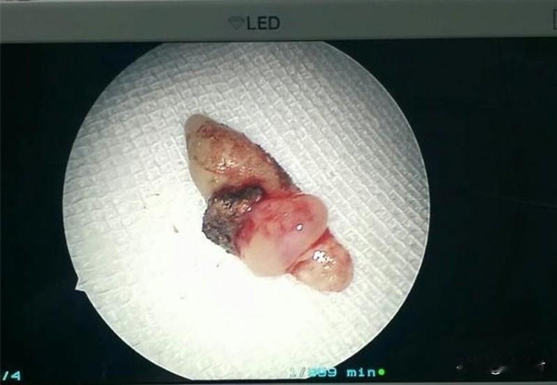 18岁女生腹中肿块里还有24颗牙齿 18岁女生腹中肿块藏24颗牙齿，想想都惊悚！