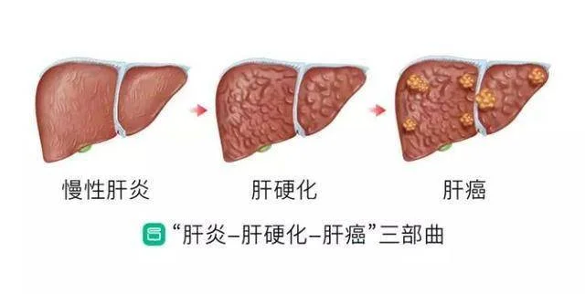 肝癌高发人群有哪些？这4类人群要警惕！ 最近接诊了一位山东济宁的患者...
