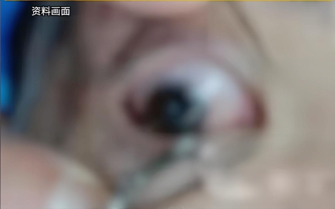 “悲剧还是发生了！”近日，重庆，一男子在野钓时，不慎将鱼钩竟钩住了路过行人的右眼