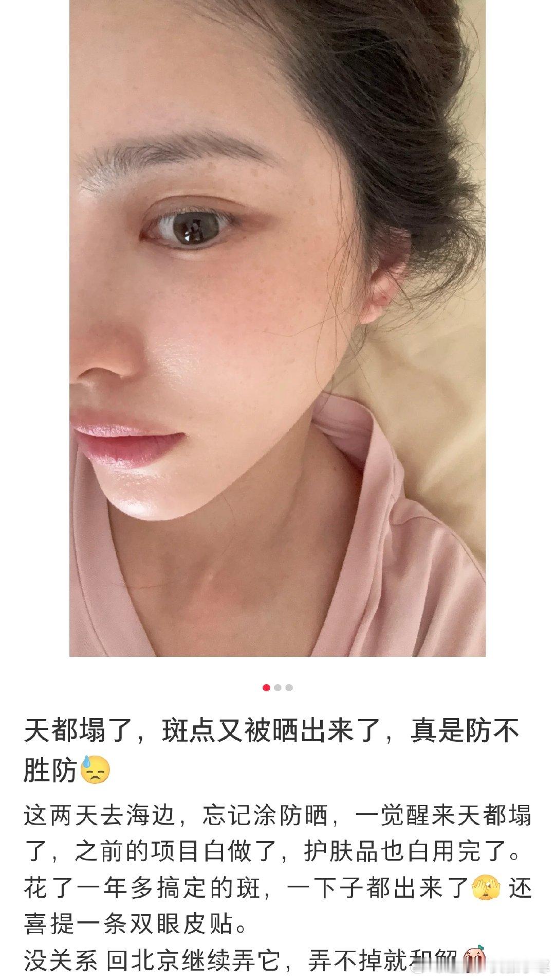 王灿旅游晒出雀斑王灿海边忘记涂防晒，雀斑直接 “集体出逃” 啦～不过咱就是说，有