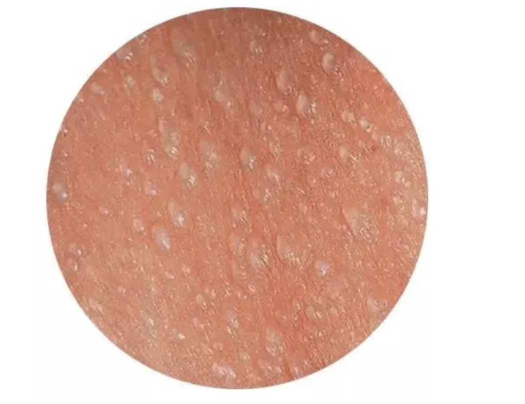 白痱子多为细小透明的小水泡，颜色发白，分布密集。多发生于孩子突然出大汗、穿戴过多