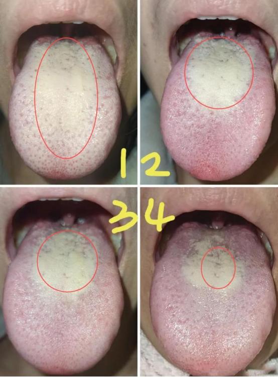 厚腻舌苔难除，中医教你一招2周时间，厚腻苔明显的从大到小！

患者主诉：睡眠质量