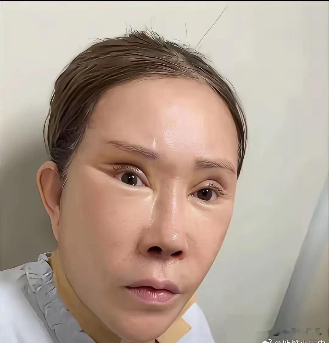 刚才看到的一位头条好友发出来的，太吓人了，这就是拉皮拉多了，等恢复完也会变形的，