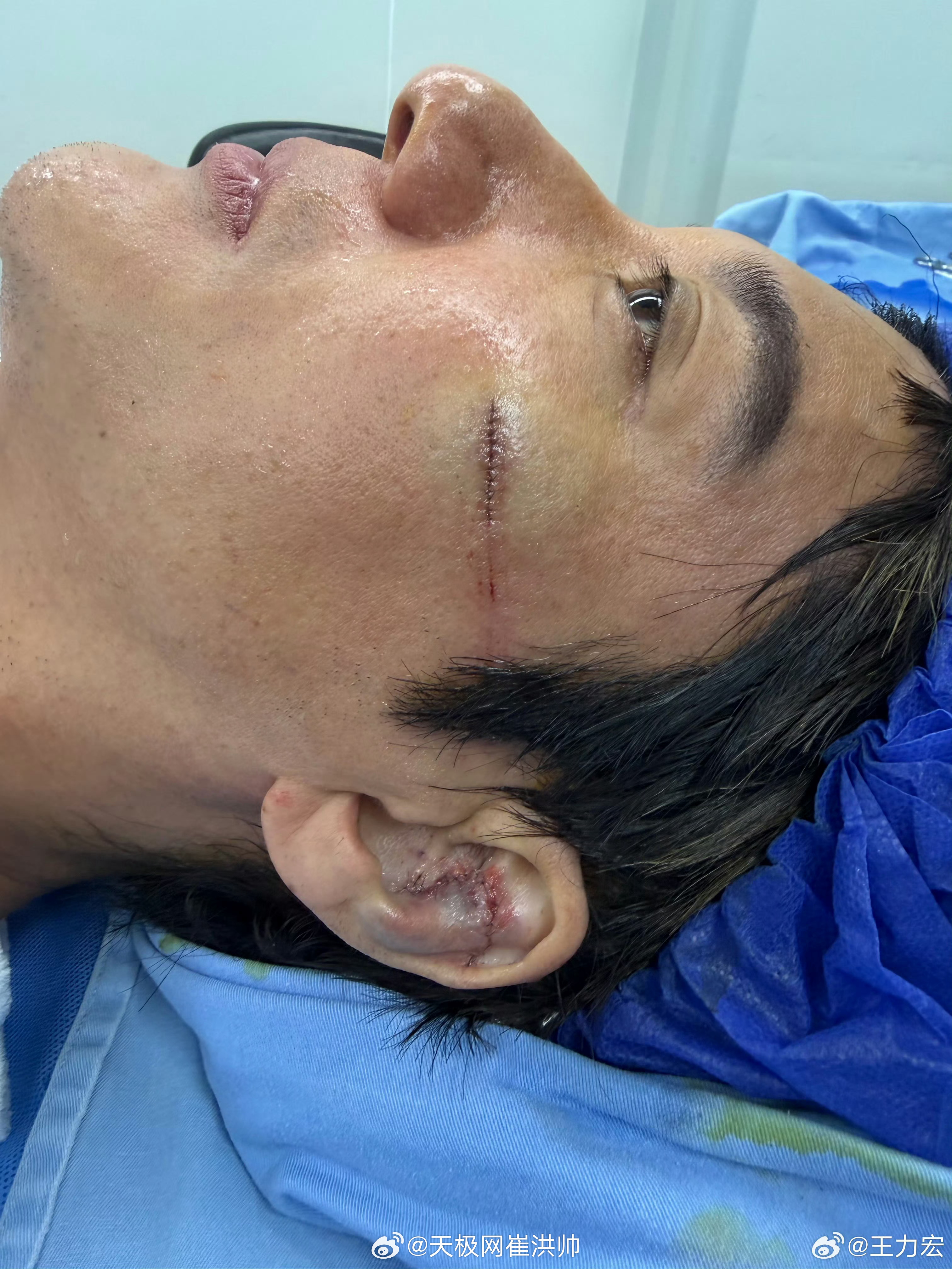 王力宏缝了39针耳朵伤口可不小，伤成这样还检查完成演出，二哥还这不是敬业，了。 