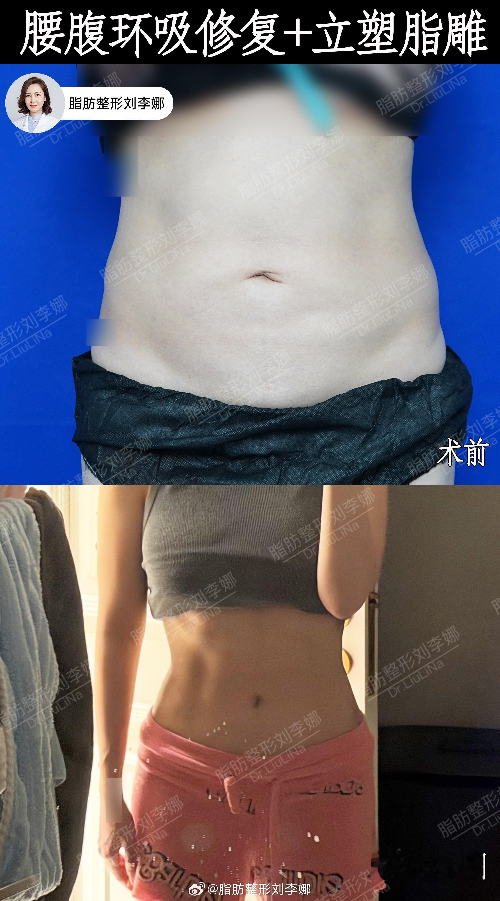 脂肪整形刘李娜腰腹吸脂腰腹失败修复 术前多年前做过一次腰腹局部吸脂，术后不仅没有