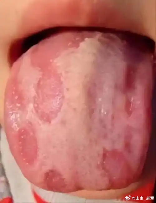 舌诊口诀苔质（薄苔）外感病轻平人薄（厚苔）痰湿宿食里证厚（润苔）风寒湿食瘀血润（