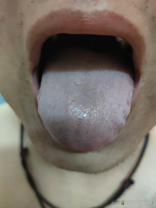 舌苔又浊，又腻，没一点血色，门诊最讨厌的舌头[狗头][狗头][狗头]
因为他的生