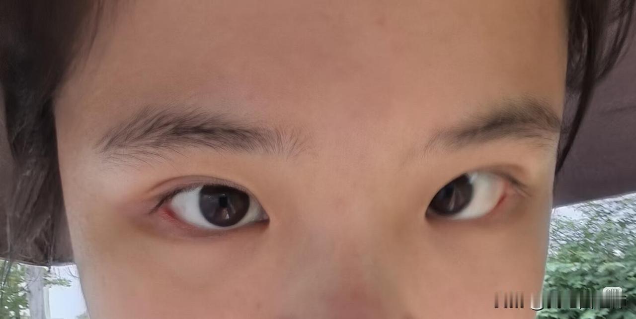 寒假兼职面试被说长相吓人
我今年19岁了，我眼睛这个样子是天生的。
	
从小就有