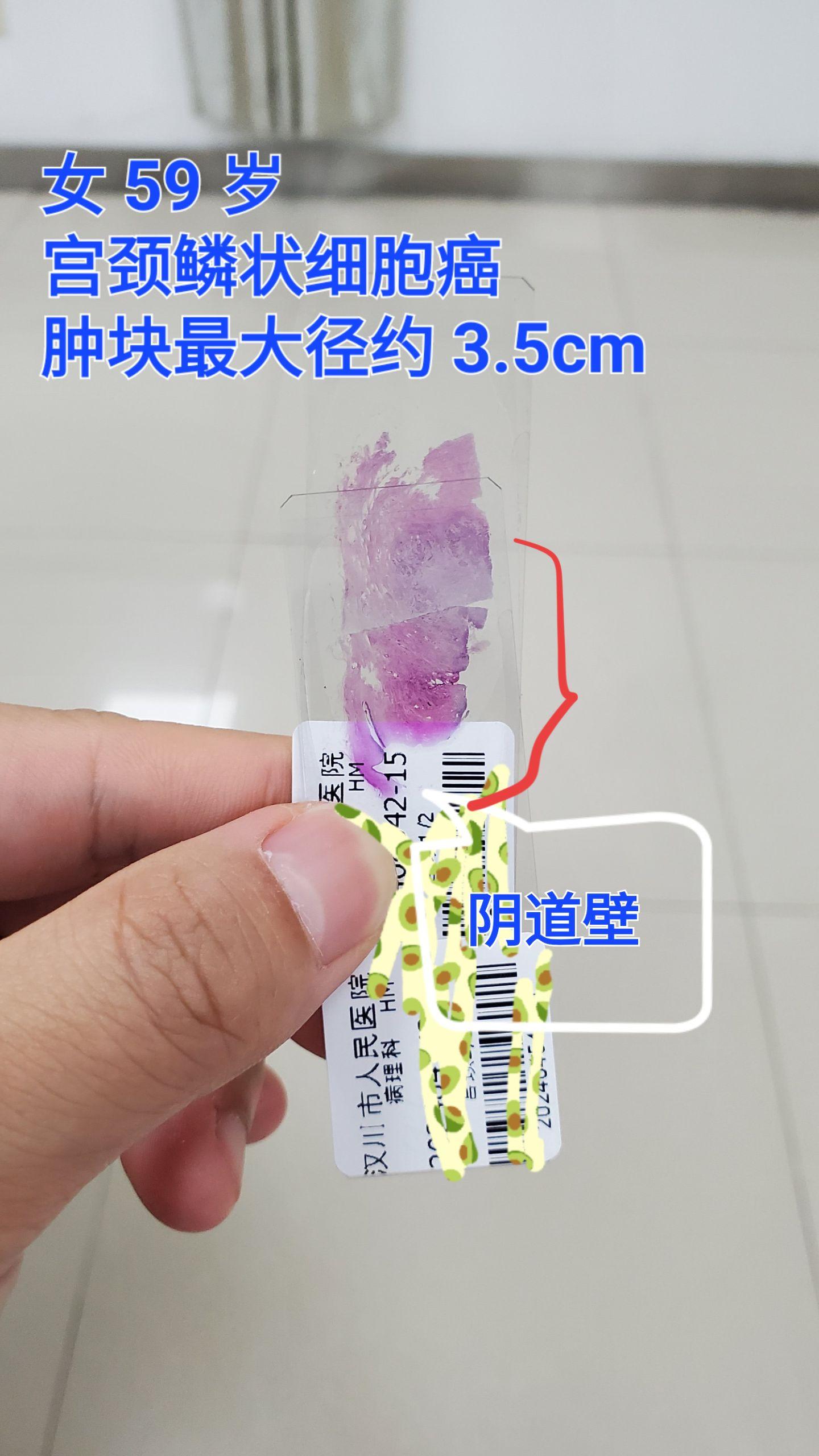 同一个鳞状细胞癌，不同分化，一般转移，浸润深的都是差分化的类型