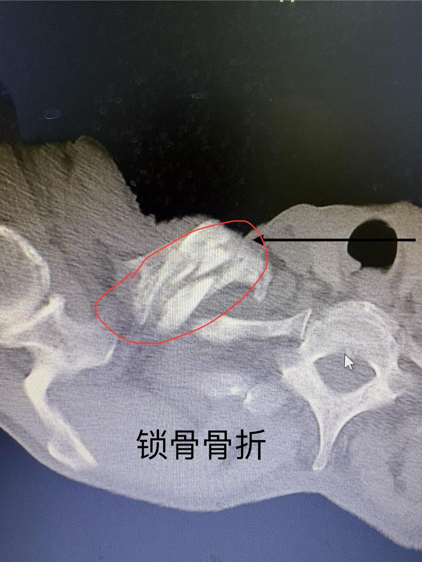 八十多岁大爷复查锁骨骨折。无意间发现肺癌，真是人生无常啊，所以定期体检...