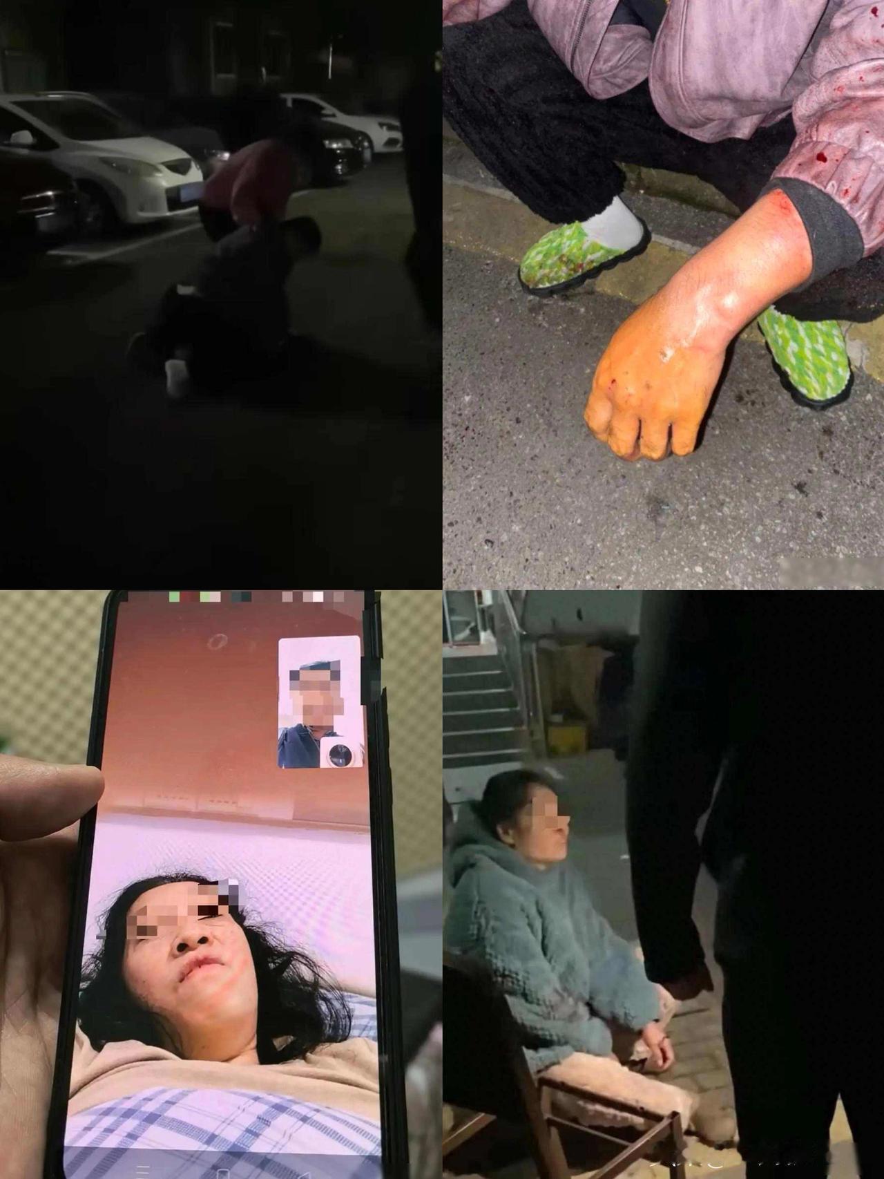 女子小区散步遭大狗咬断手筋，
小伙冲下2楼摁住肇事狗，手掌被咬穿，
最新情况——