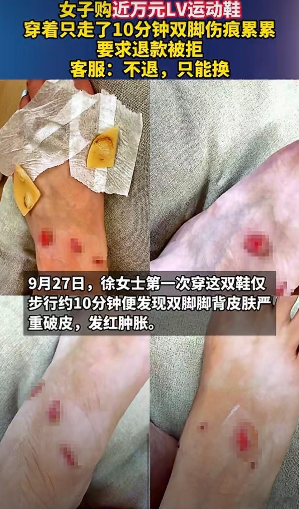 女子穿LV鞋10分钟致脚伤退款遭拒没穿过这么贵的鞋子，但是新鞋子真的很容易磨脚的