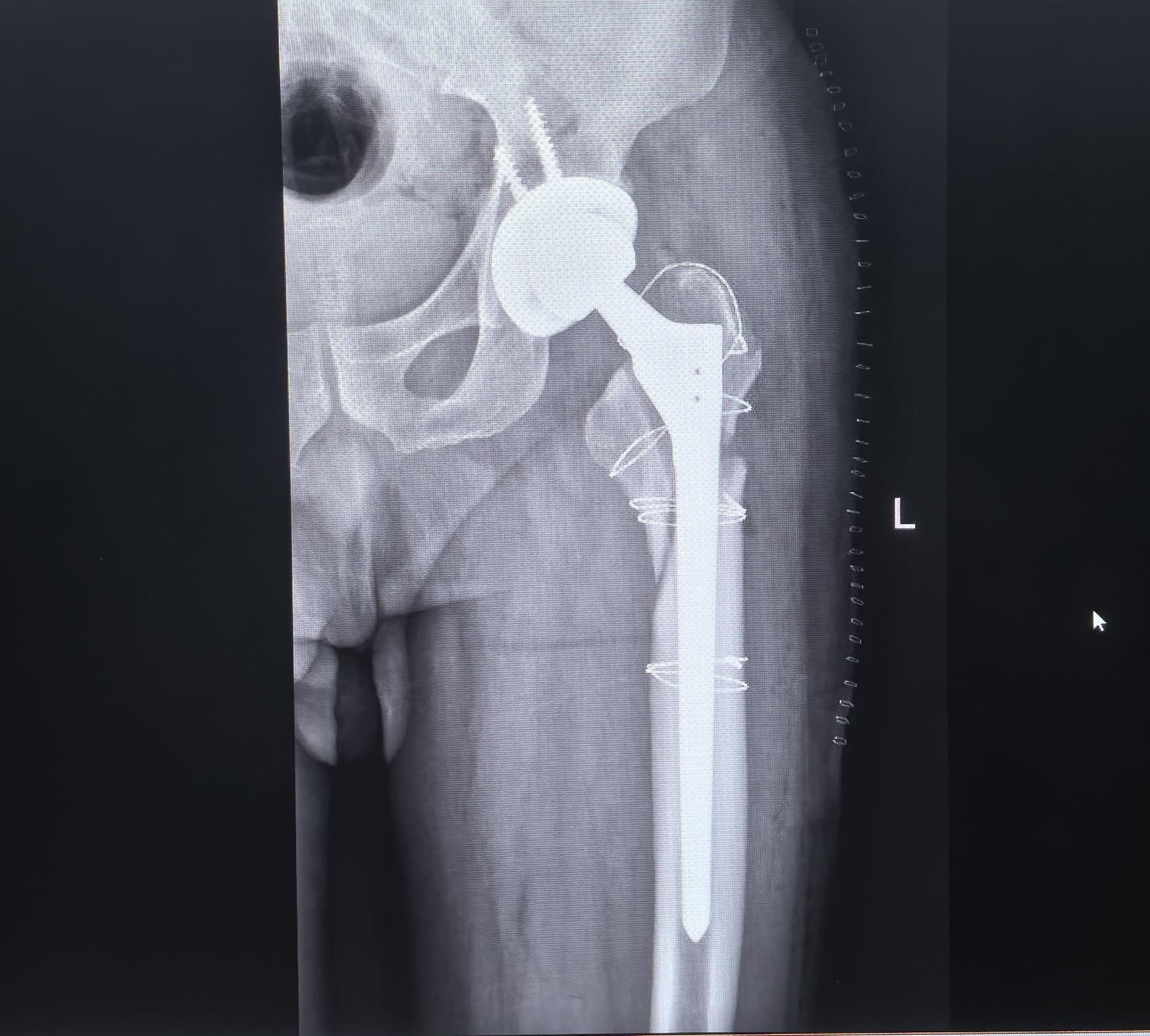 髋关节置换术后假体周围骨折。老年人一定要重视骨质疏松的预防（抗骨质疏松...