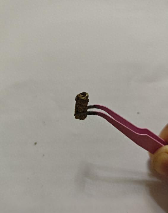 谁能想到，一次普通的眼部小手术，竟能砸掉一位掌勺大厨的饭碗，甚至偷走她整整14年