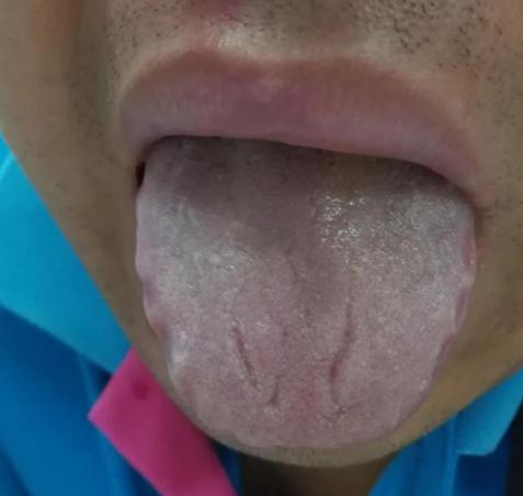 前几天有人问我，舌头上总有三两道裂纹代表啥？
这个问题代表了很多人的看法
有些人
