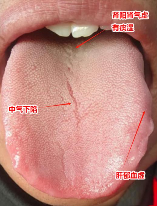 晚上总“下车快”，上车费劲，阳虚怕冷，乏力，但用桂附地黄+六君子没用，原因就在舌