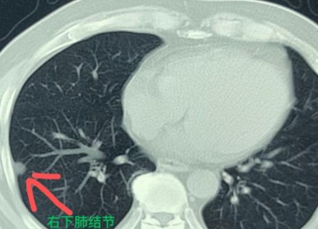 68岁男性患者，因为感冒后咳嗽一直没好，就来医院做了个胸部CT。结果偶然发现，右