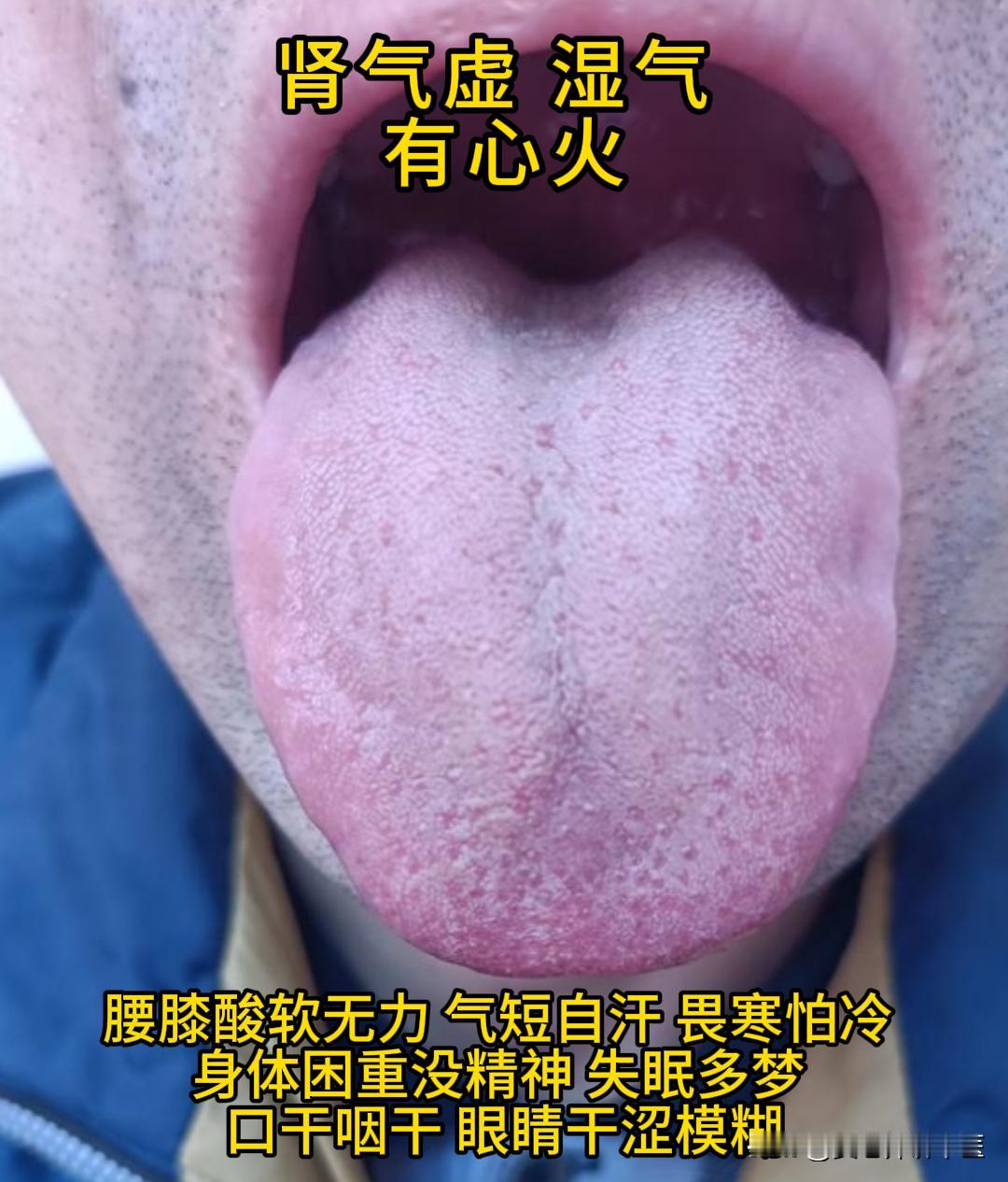 这会有时间，可以帮大家看看舌象。

有需要的，尽管把你的舌象照片发过来吧！越早发