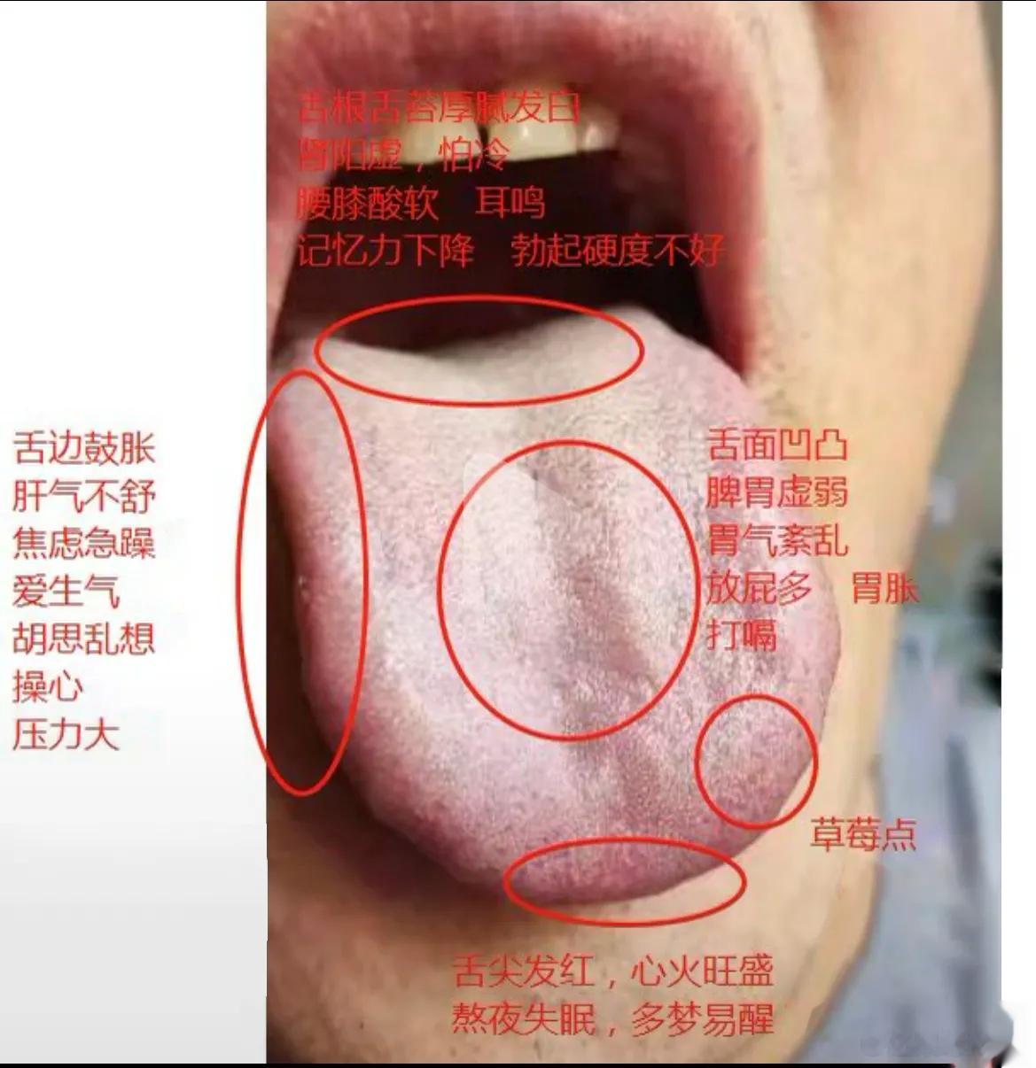 【粉丝舌象分析：胃胀，半夜易醒，功能萎弱短促】1、舌中面凹凸不平，说明气机不顺畅