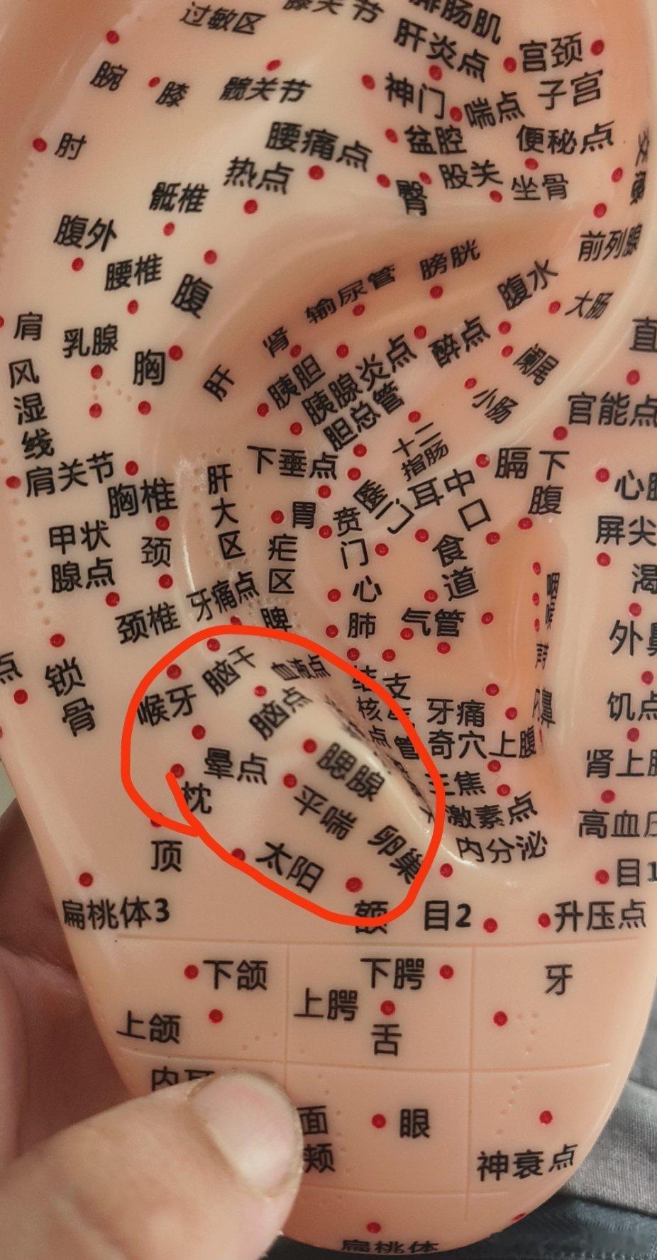 头痛焦虑，头胀睡眠不佳给他除了针灸，用了耳穴疗法按压，效果出来了感觉中医的确有用