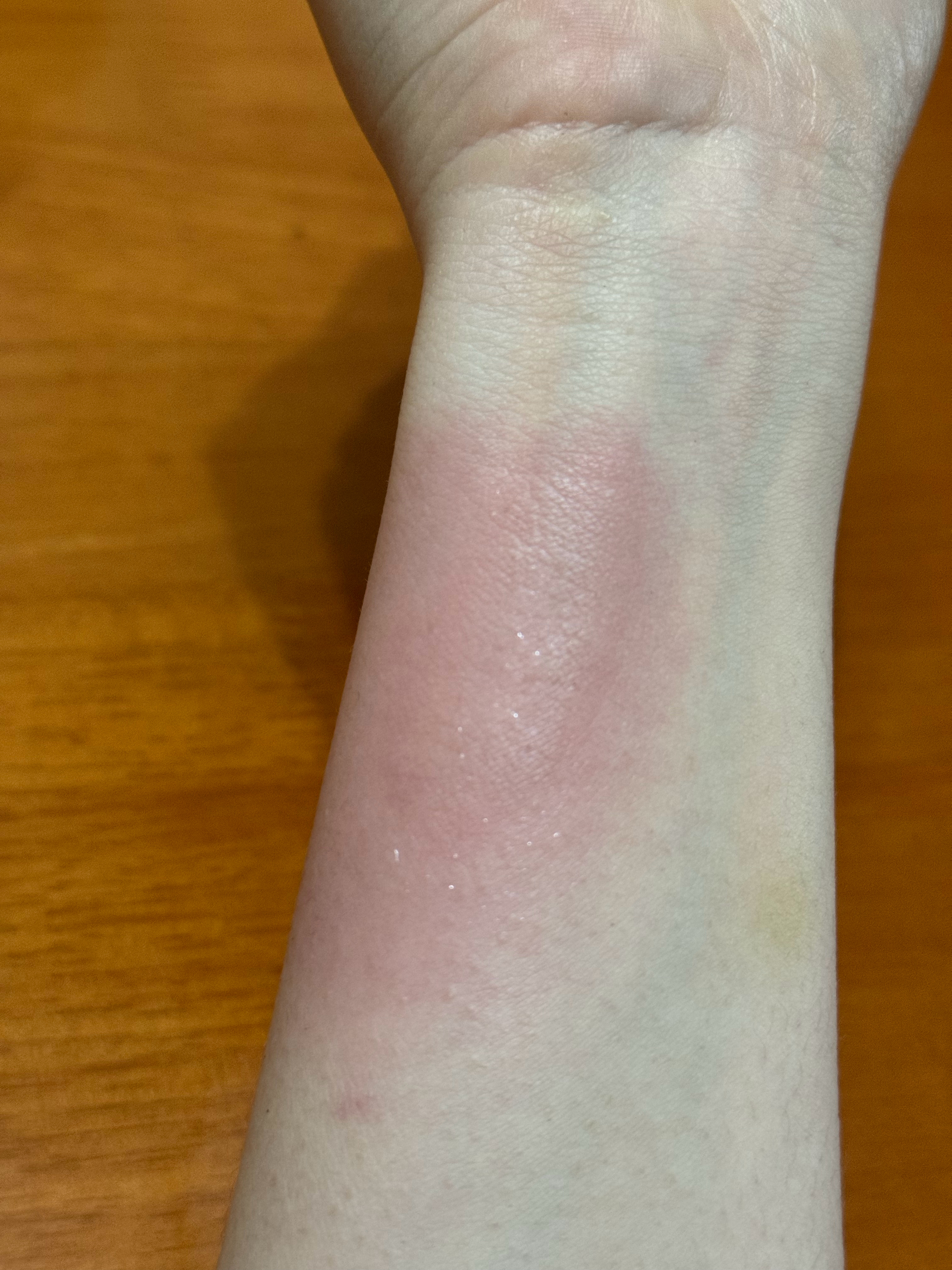 有点好奇 被高温烫伤之后的皮肤 是不是和被烫熟的🥩一样 细胞全死了。。。不知道