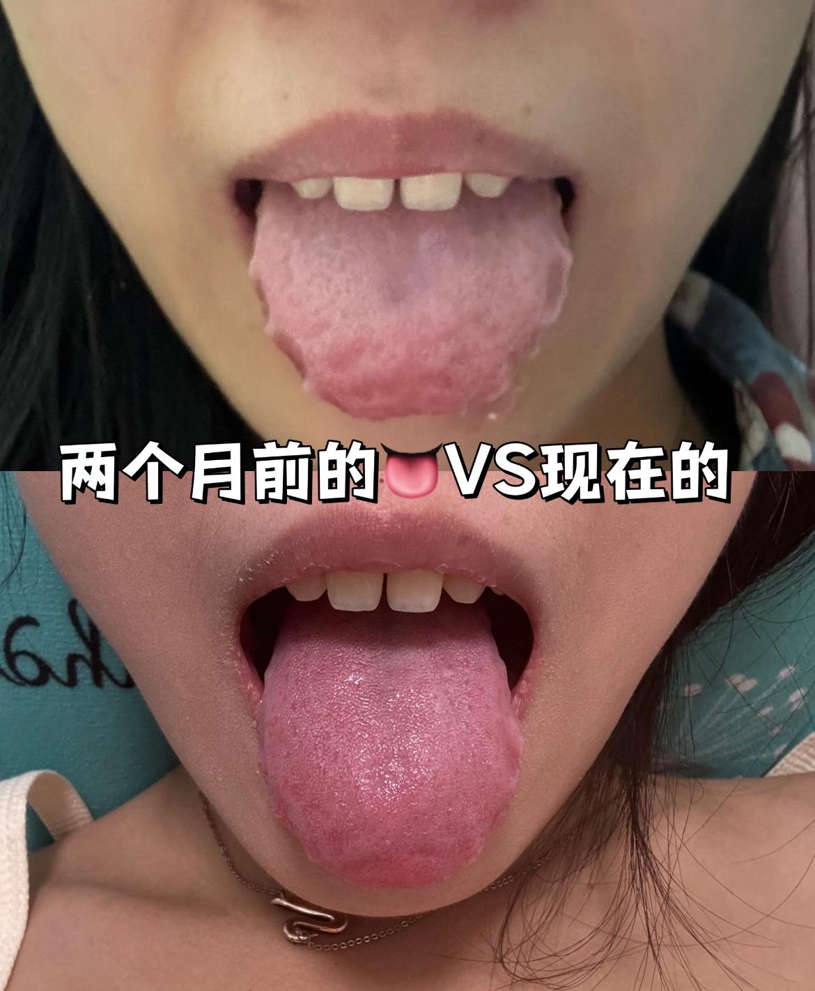 齿痕舌很简单，一直调不好的，只是你方法不对！
门诊上面，我经常碰到这样的患者，一