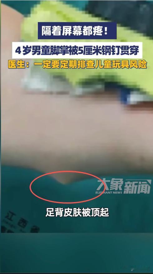 “悲剧还是发生了！”近日，江西，一4岁男孩在玩耍时，脚掌一下被一根5厘米长的钢钉