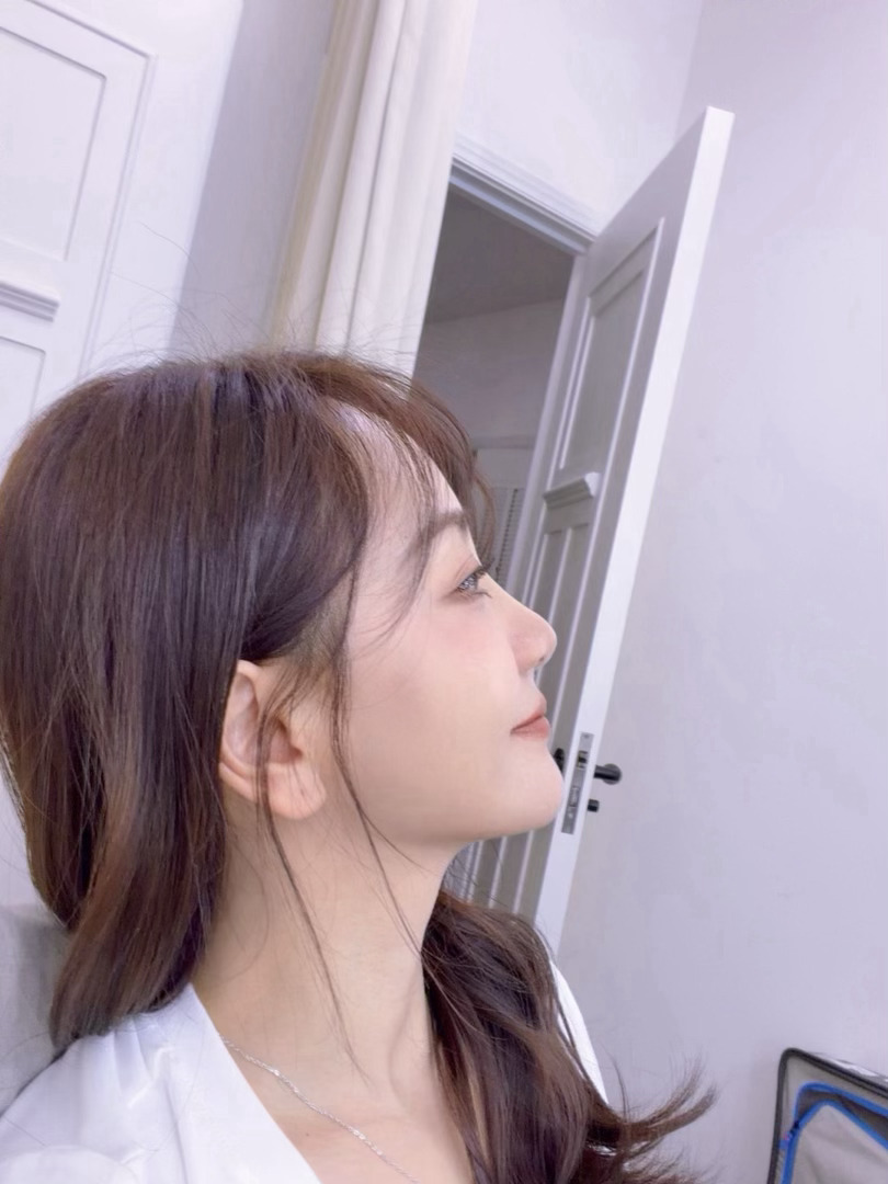 杨蓉面部烫伤恢复近照演员杨蓉在工作中意外被疑似卷发棒烫伤右脸。初期她误用新鲜芦荟