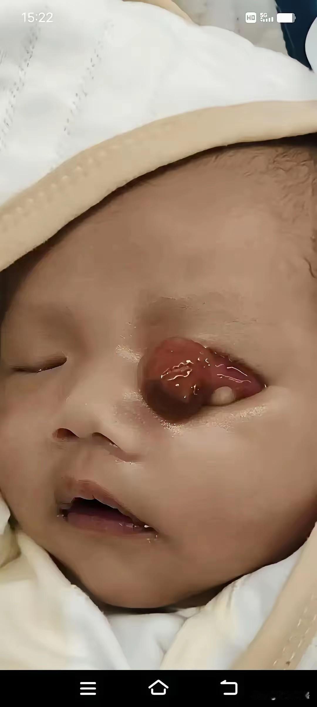 这可怜的孩子，刚一出生，眼睛上就长了一个这样的东西，看起来像是一个肉球，看来这肉