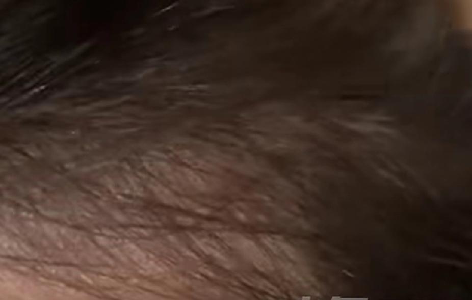 女子染发头皮溃烂，过年只能光头，近日浙江的陈大姐本想洗剪烫染一条龙，美美的过年，