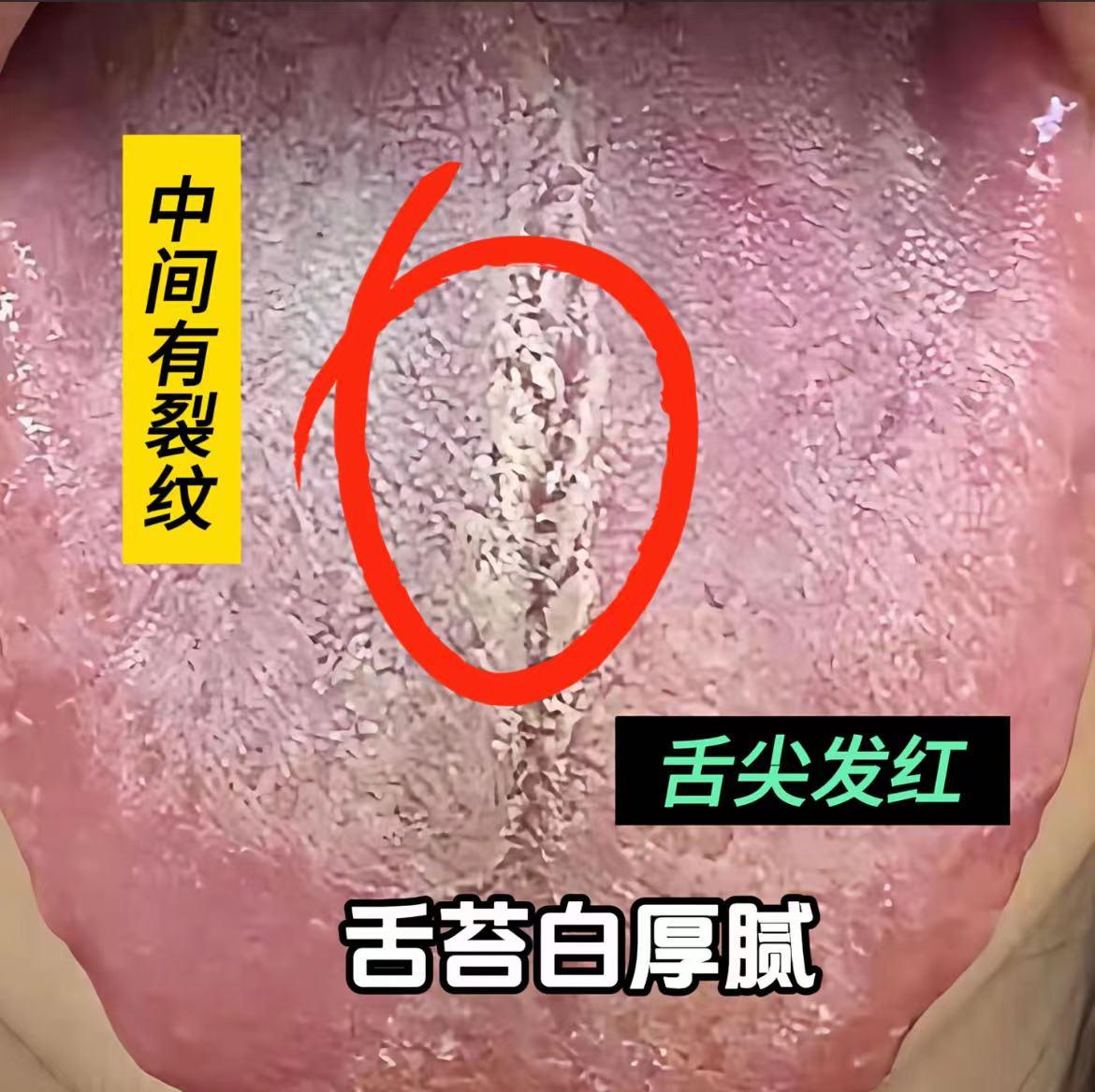 33岁的小兄弟，肾虚+湿热，舌头真不像话！[求抱抱]
患者叙述：年轻时欲望极强，