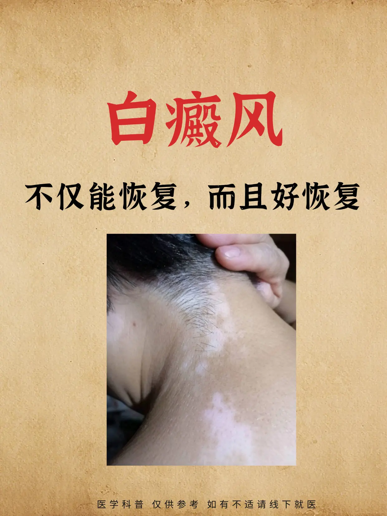 医学科普 白癜风 白斑 硬核健康科普行动 皮肤健康