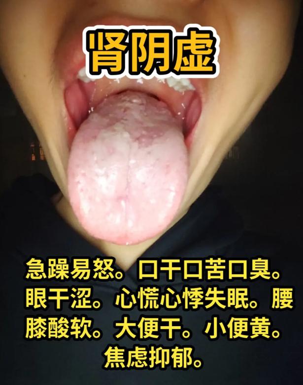 3 种常见男性复合体质舌象，对照自查，精准辨证