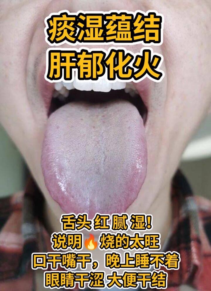 #舌苔辨证 #齿痕舌 #裂纹舌 #中医 #调理脾胃