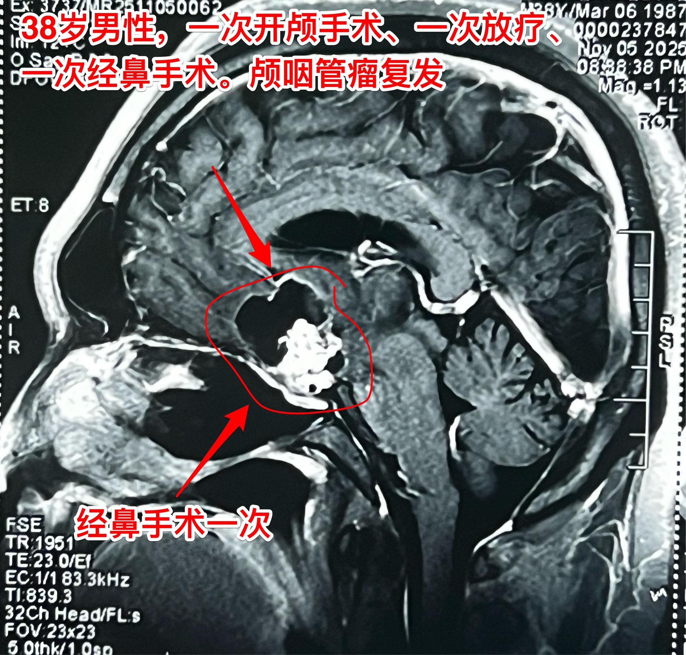 多次治疗后又复发的颅咽管瘤-不要轻易放弃。38岁福建男性，颅咽管瘤复发...