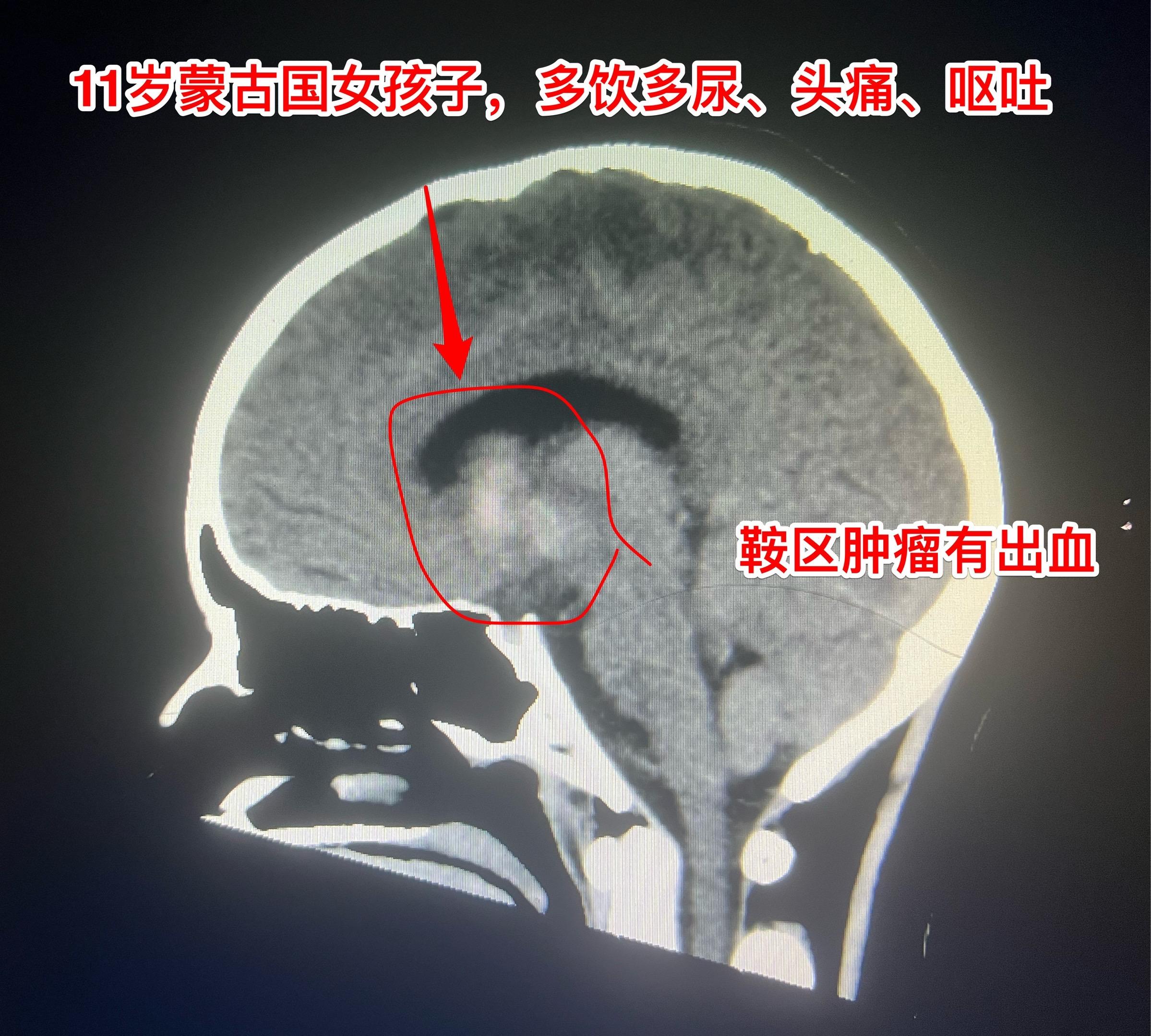 11岁蒙古国女孩子4月11日突发头痛呕吐。11岁蒙古国乌兰巴托女孩子...