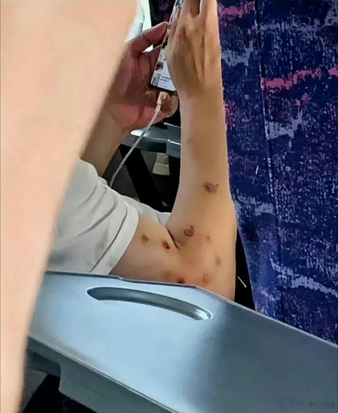 我国发现猴痘病毒Ib亚分支聚集性疫情 上次，网友坐车发现的，这是传说的猴痘吗？ 