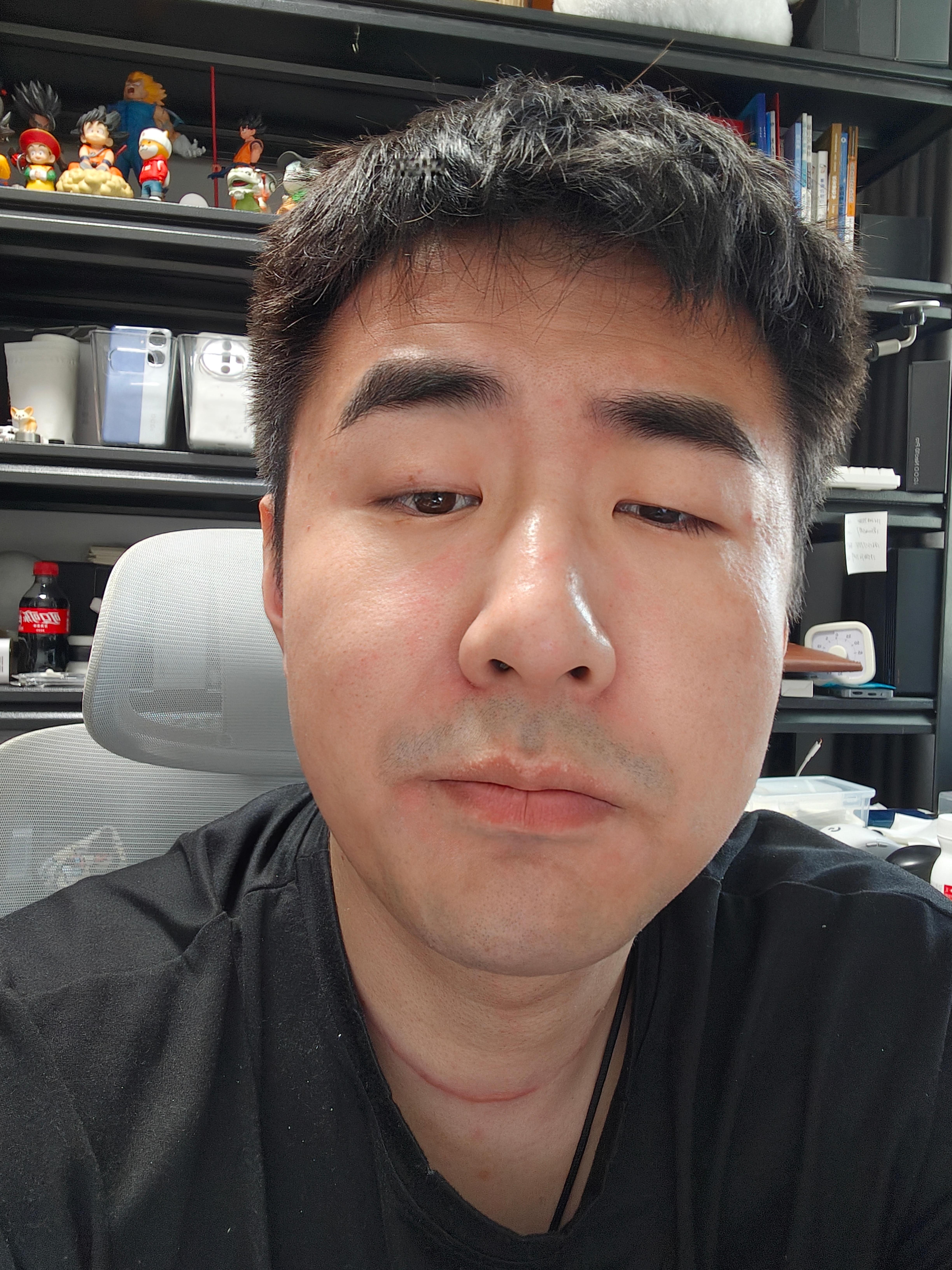 每次陪媳妇做脸都是被扎满脸针眼 